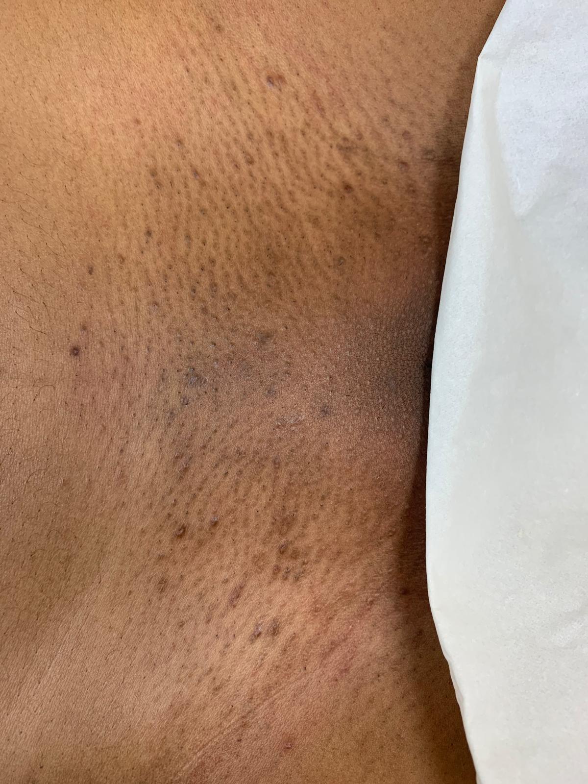 After laser hair removal treatment, example 2