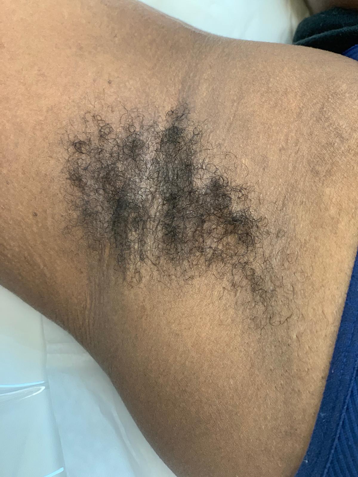 Before laser hair removal treatment, example 1